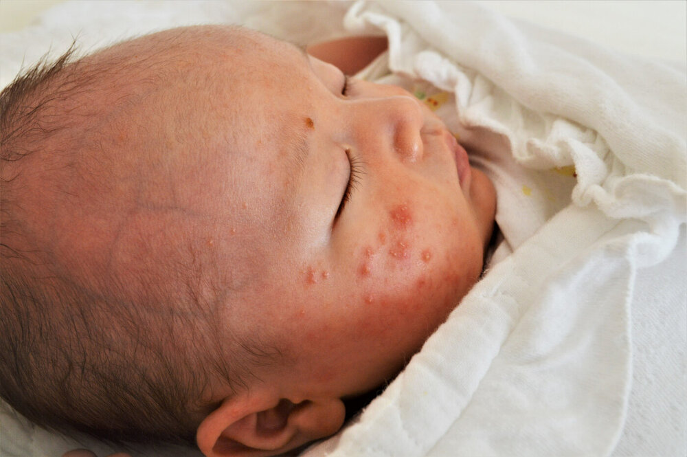 赤ちゃんの顔にできる赤いブツブツ「乳児湿疹」
