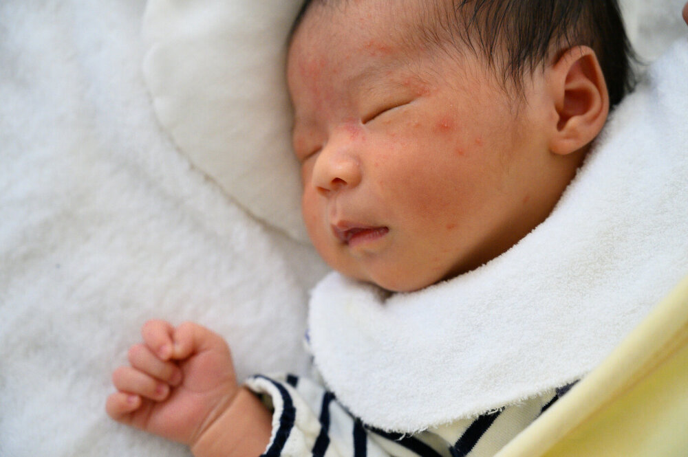 乳幼児に湿疹ができる主な3つの原因